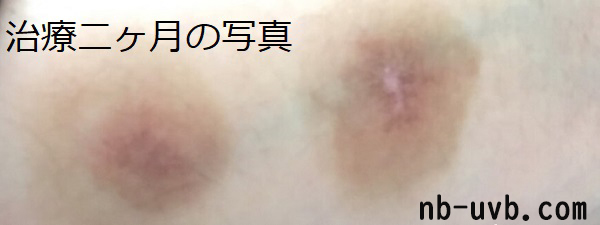 家庭用ナローバンドUVBの白斑治療例