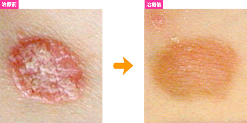 乾癬治療例02