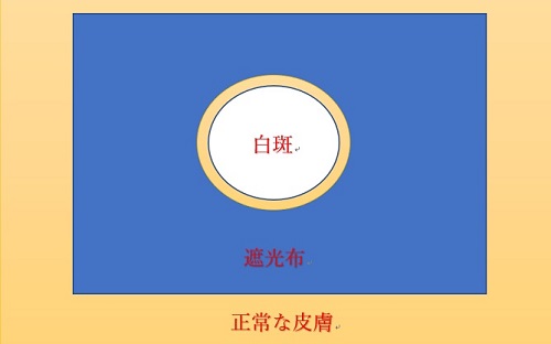 白斑にナローバンドUVB