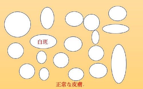 白斑にナローバンドUVB